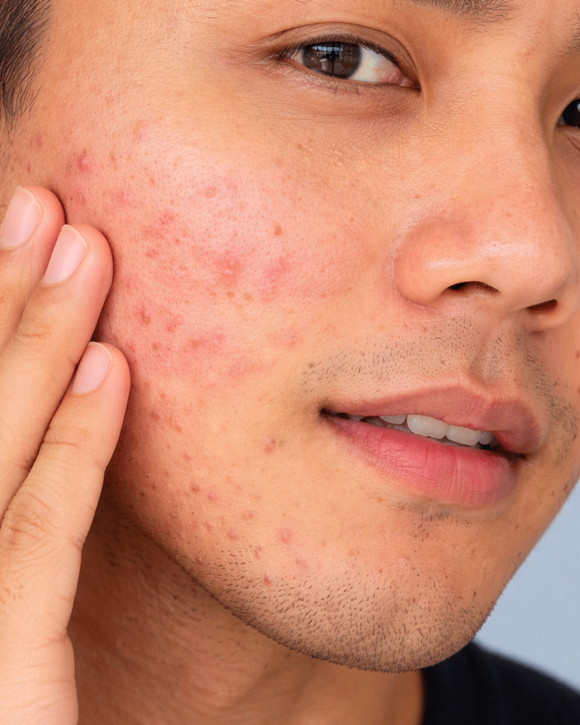 Adult Acne Is Not a Teenage Story Repeated